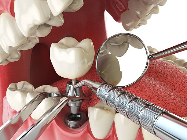 Best Emergency Treatment for Dental Infections or Abscesses in Bonnetsville, NC